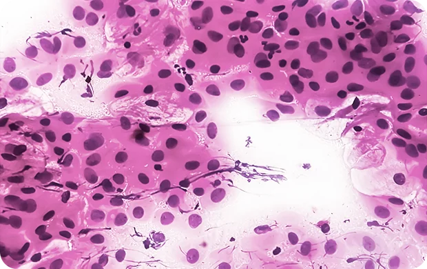 Cáncer de Cérvix o Cervicouterino