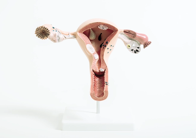 Miomatosis