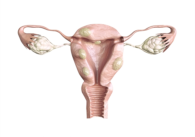 Miomas uterinos